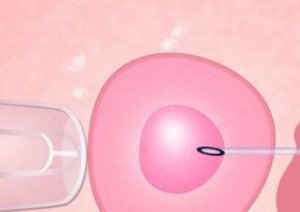 对试管婴儿认识上的误区有哪些？