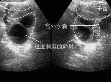 乳房里有硬块正常吗？乳腺疾病应该吃什么？有乳腺疾病可以做试管婴儿吗？